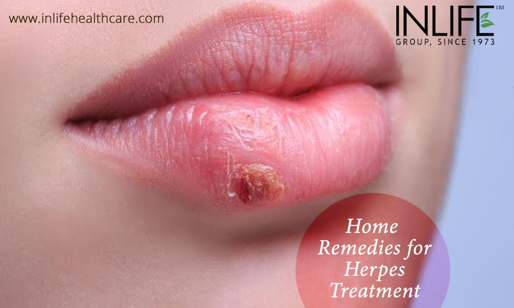 Home Remedies for Herpes Treatment